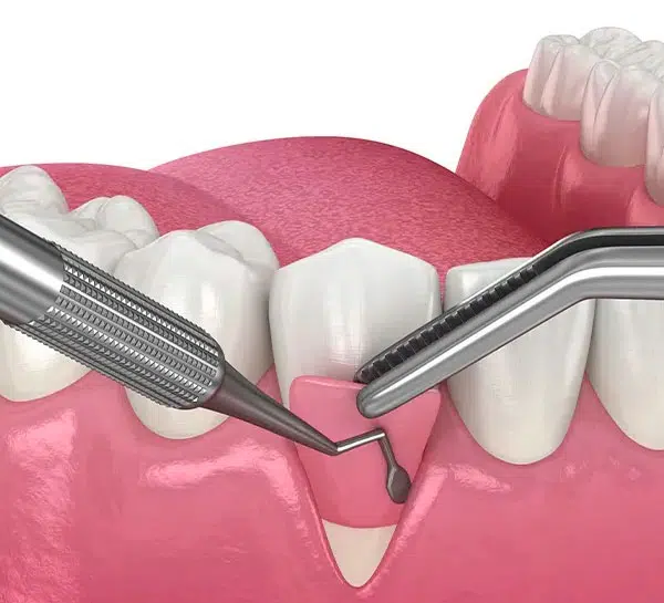 Flap Surgery